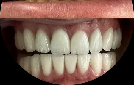 Brytsmile Teeth Whitening